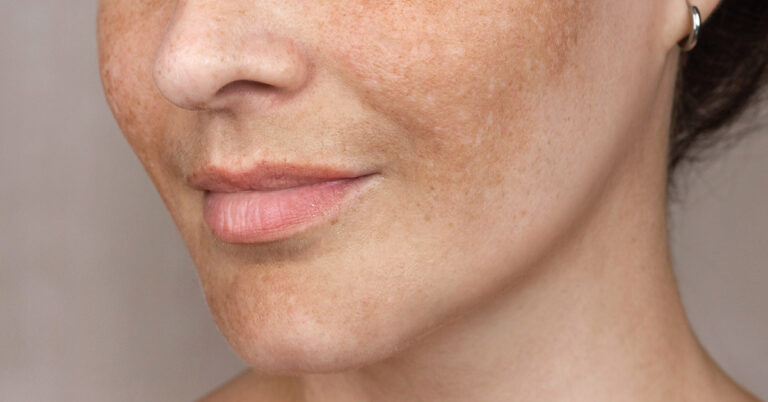 How To Reduce Age Spots: Causes, Treatment, and Prevention