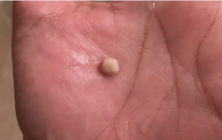 Here’s What You Need to Know About Tonsil Stones