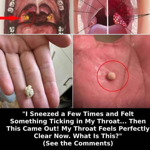Here’s What You Need to Know About Tonsil Stones