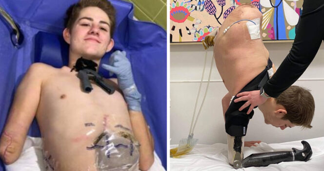 19-year-old crushed by forklift chooses to amputate bottom half of his body