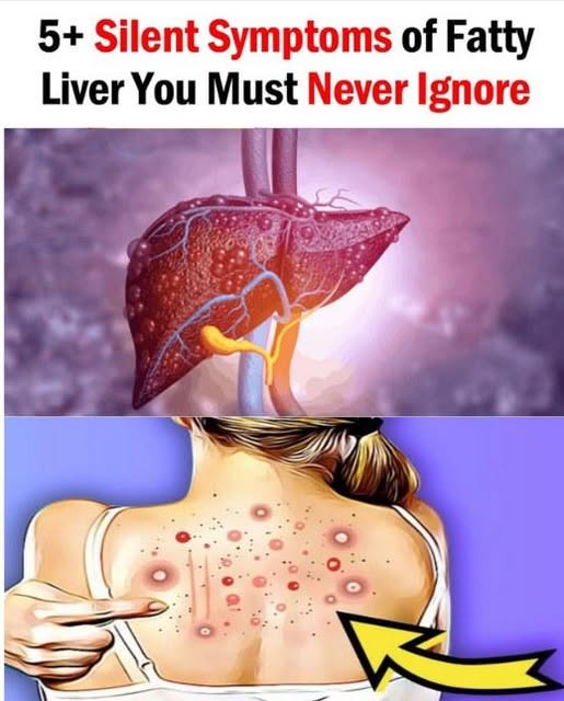 Fatty Liver: Causes, Symptoms, Treatment & Home Remedies