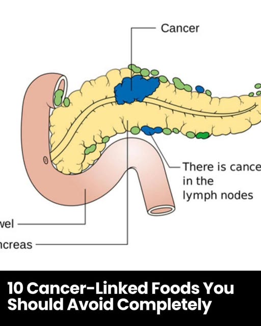 10 Cancer-Linked Foods You Should Never Put in Your Mouth Again
