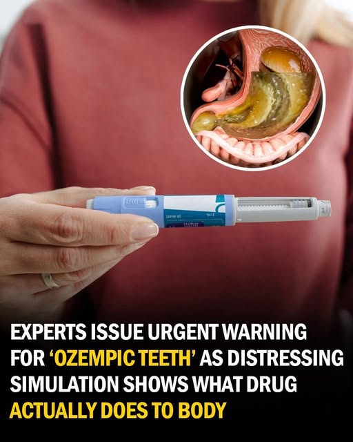 Exploring Reports of Tooth Issues Linked to Ozempic Use