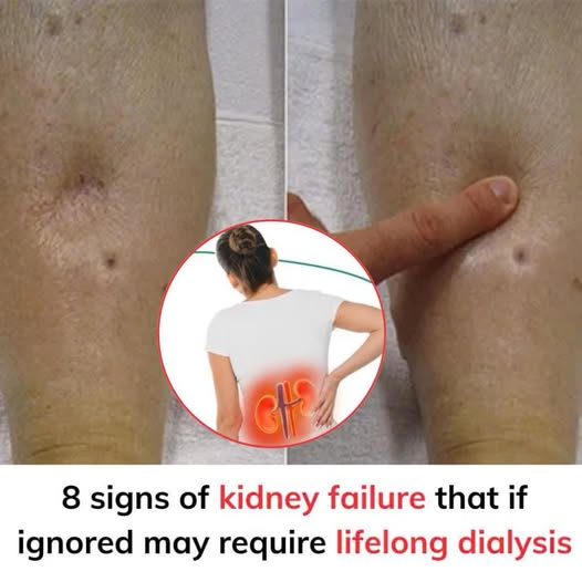 If Your Kidneys Are in Danger, the Body Will Show these 10 Signs