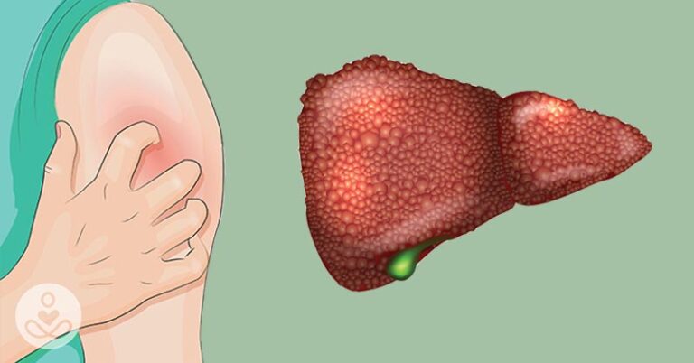 Bruise easily? Itchy skin? 5 signs you have liver damage without even knowing it