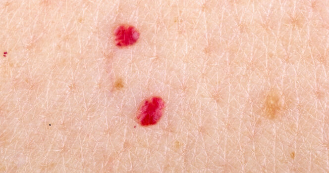 If you spot these red dots on your skin, here’s what they mean