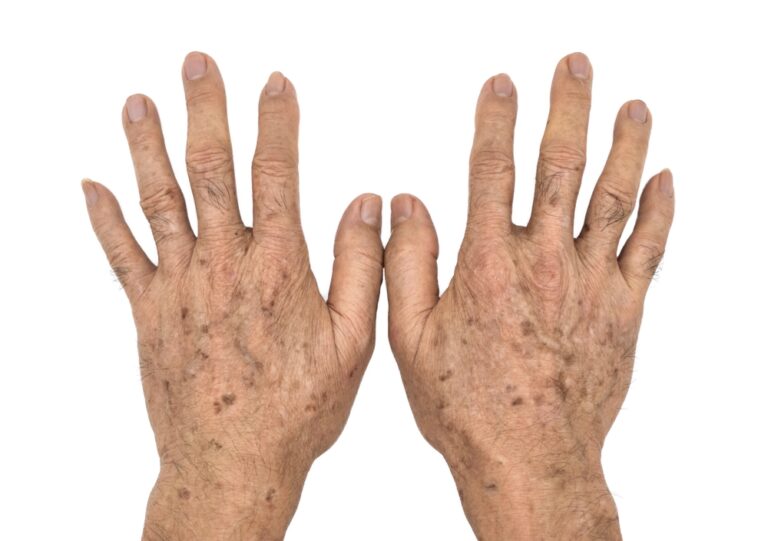 How To Reduce Age Spots: Causes, Treatment, and Prevention
