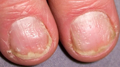 Doctor Reveals 7 Health Conditions You Can Spot By Just Checking Your Nails